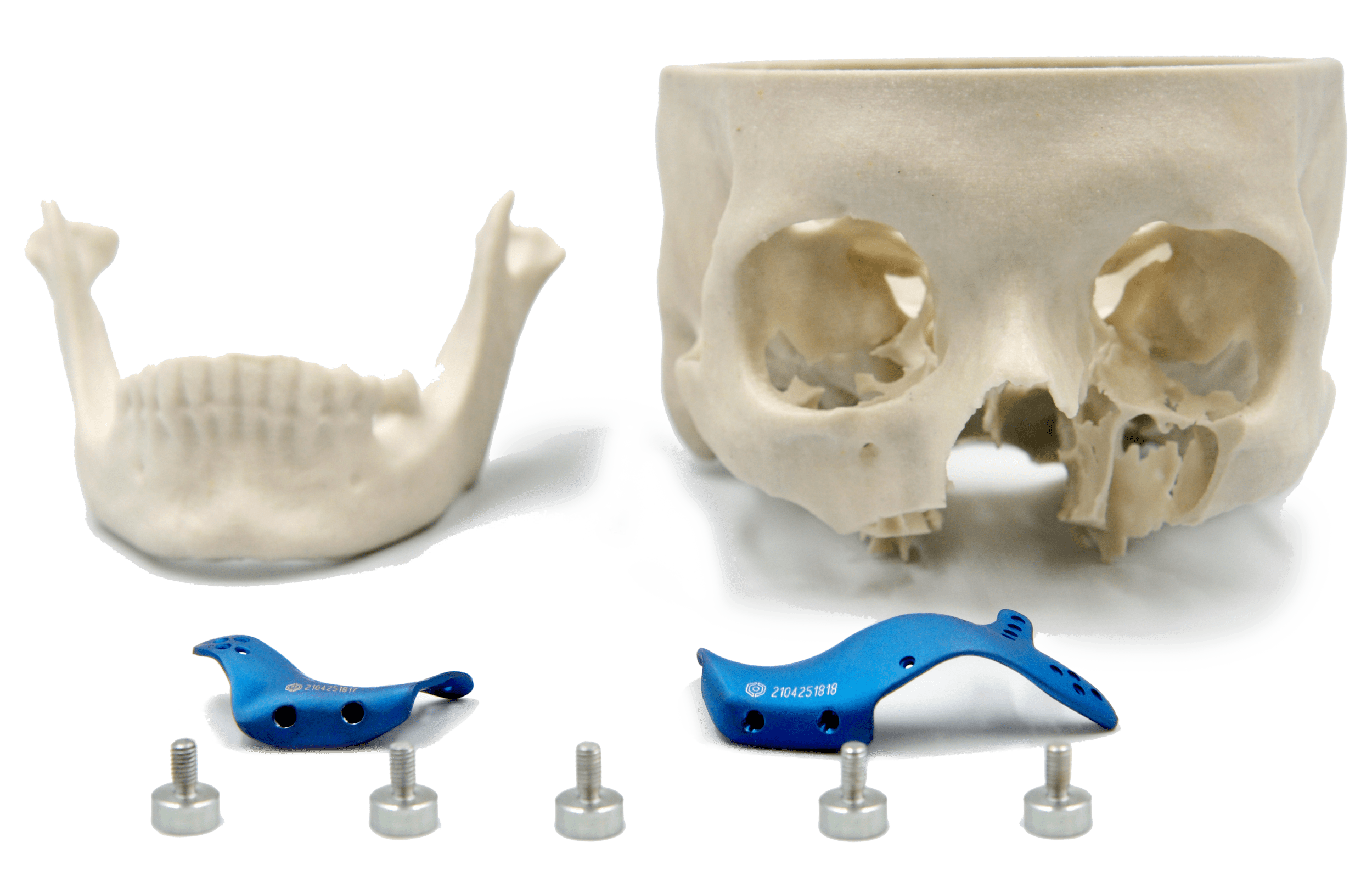 Próteses de maxila em titânio com parafusos e biomodelo ao fundo