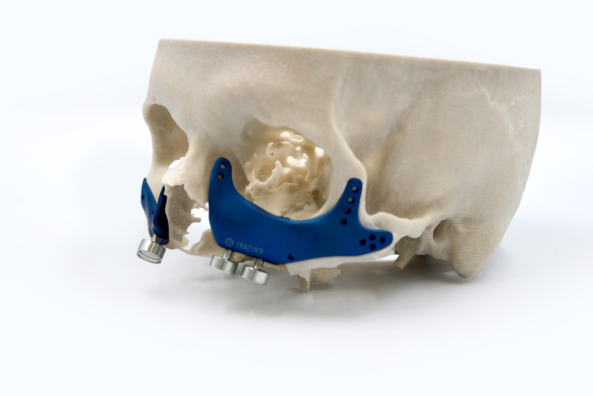 Prótese de maxila com ímãs em biomodelo
