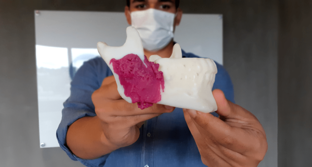 Biomodelo de tumor na mandíbula