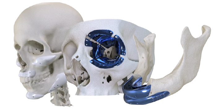 Implantes sob medida: soluções ba•io