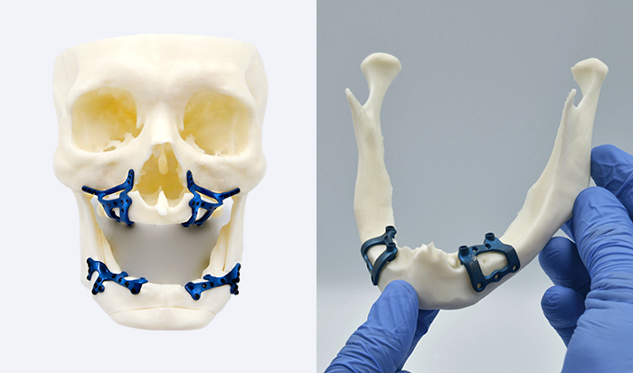 Prótese Maxilar E Mandibular Com Goma No Sistema 4 Apoiada Por